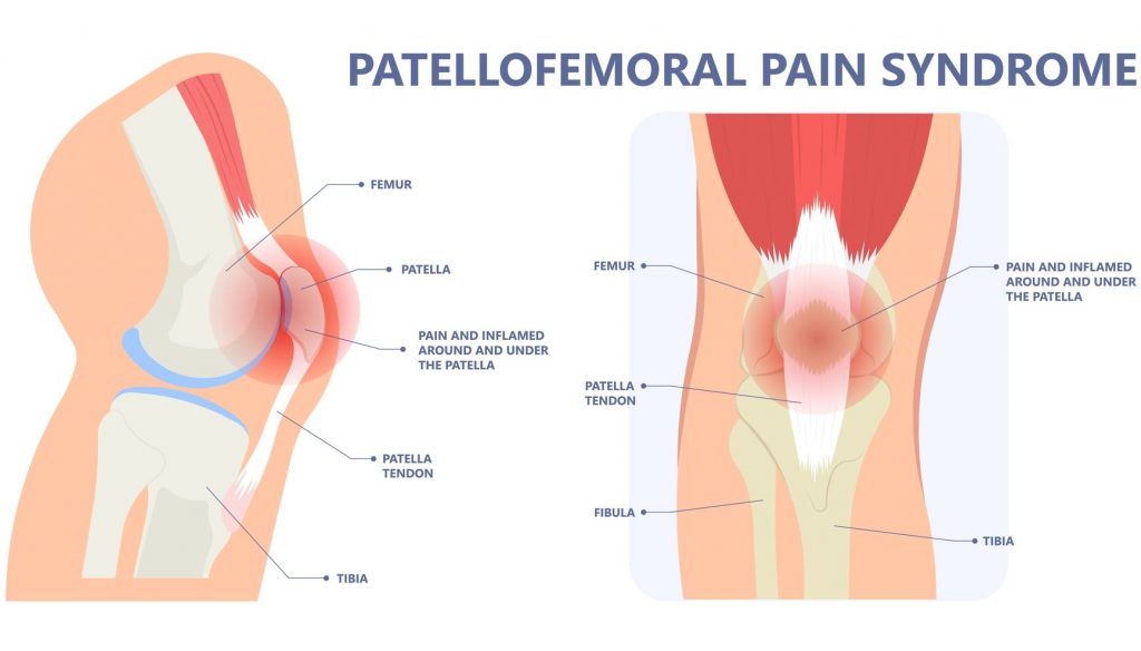 patellofemoral pain syndrome
